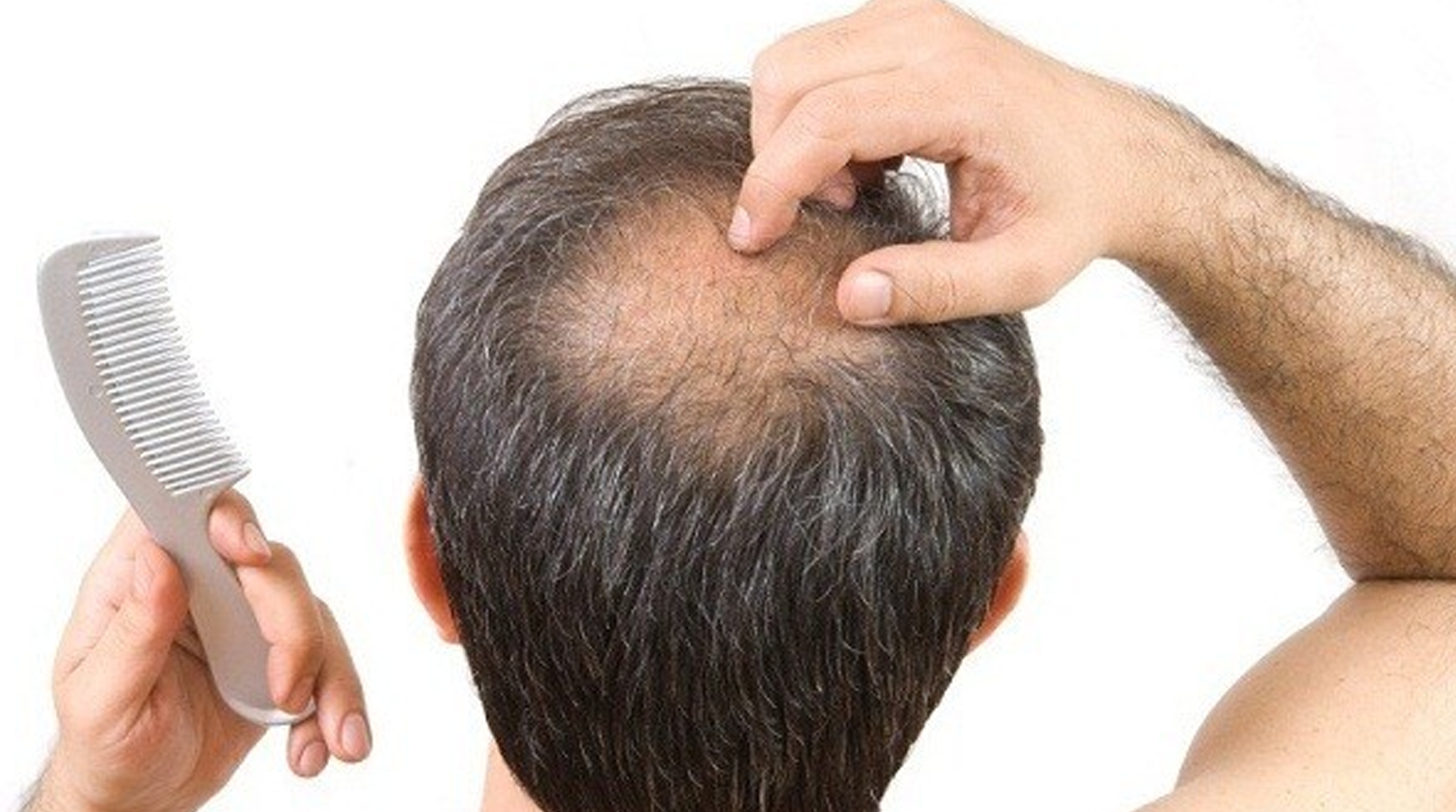 Alopecia areata 3 products for bald patches on your head  Hair Growth  Specialist  The Hair Growth Specialist
